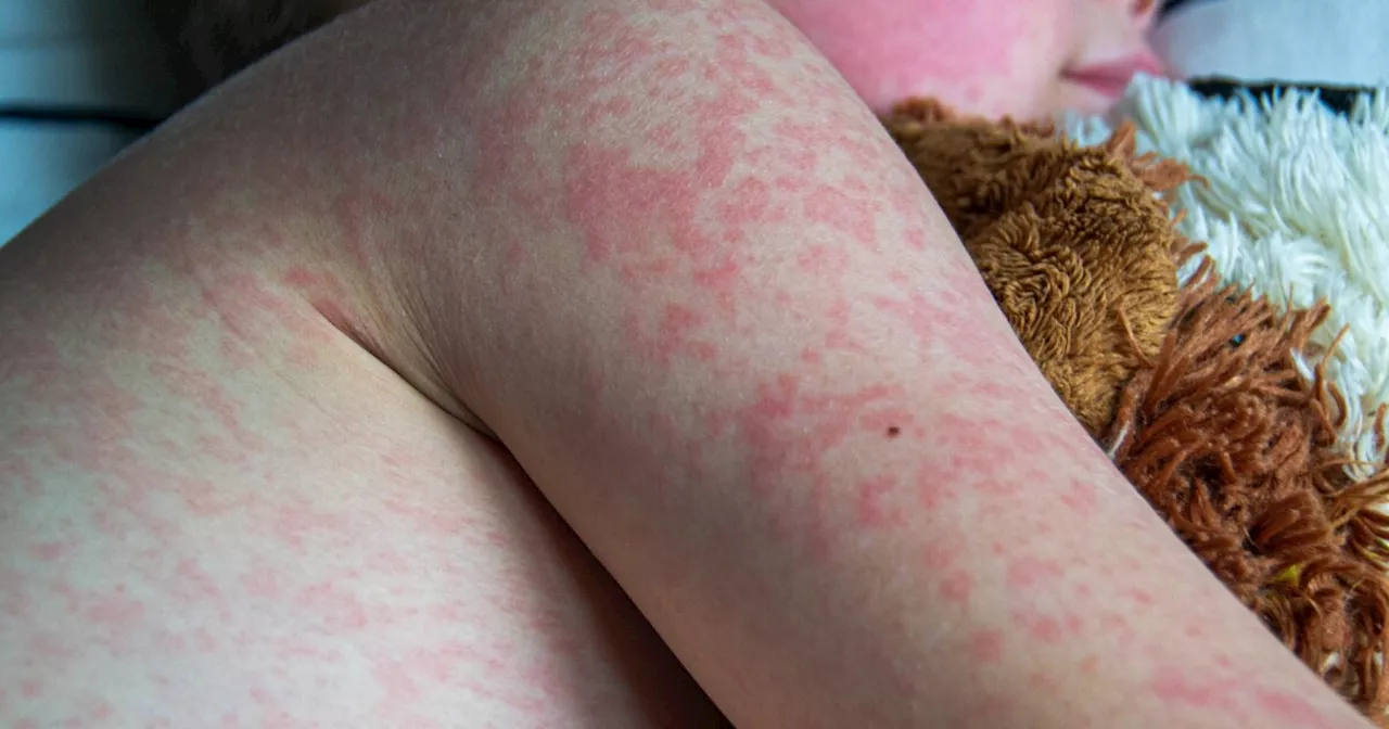 Measles: A Public Health Threat Resurfacing