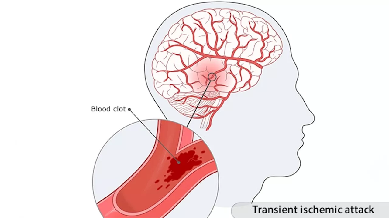 First-Time Transient Ischemic Attacks Linked to Long-Term Cognitive Decline