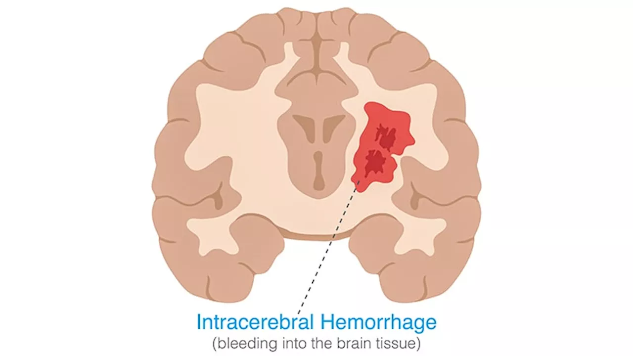 Minimally Invasive Surgery in ICH: More Encouraging Data?