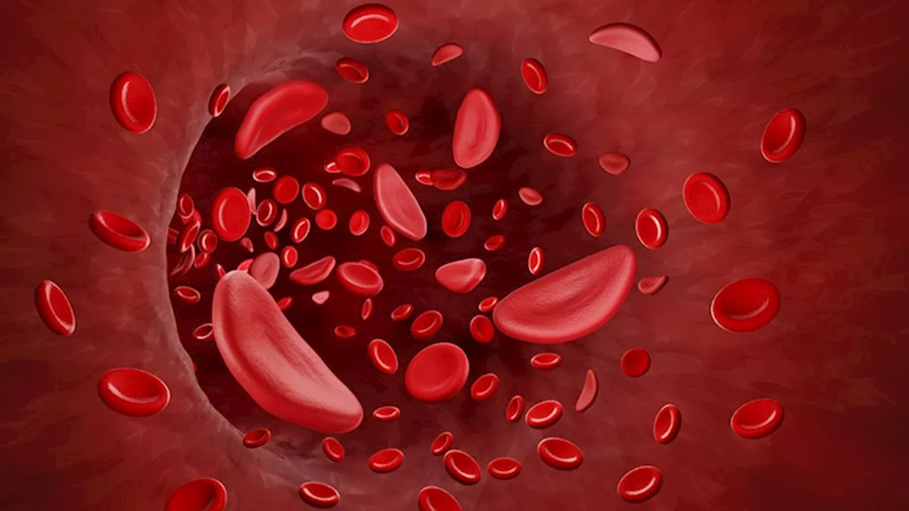 Sickle Cell Trait Widely Misinterpreted As Cause of Death