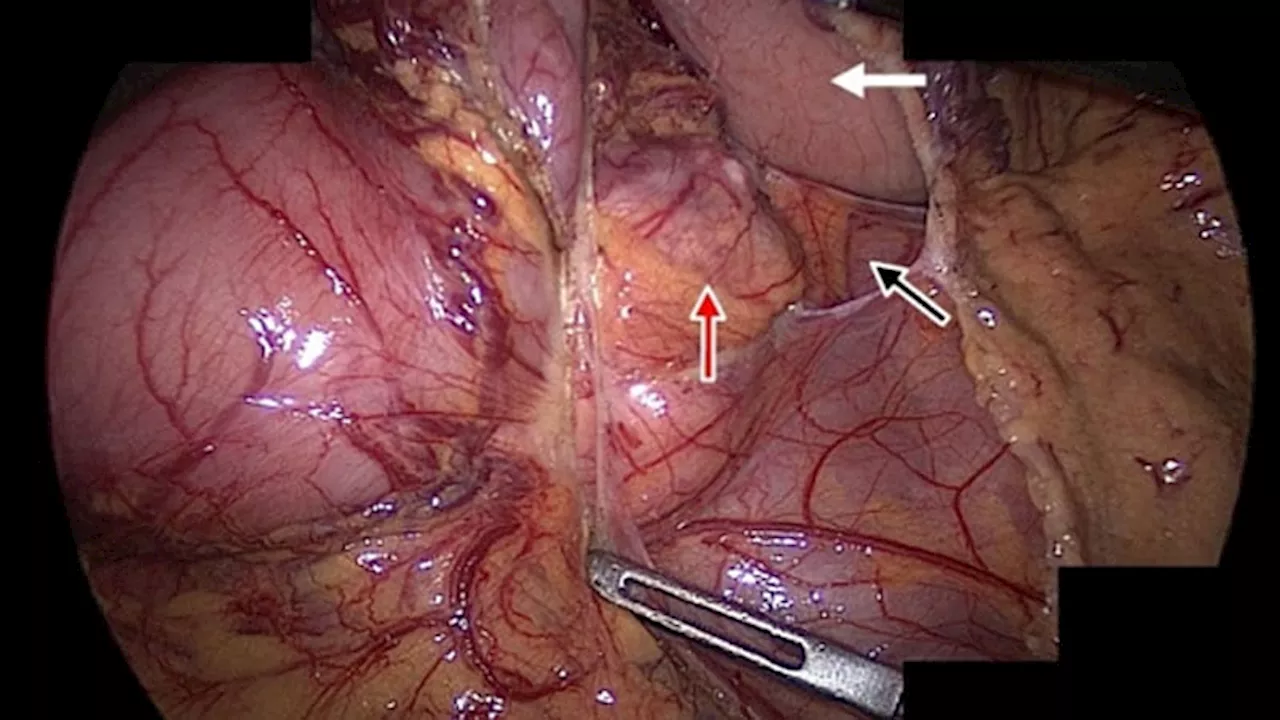 Cabozantinib Improves PFS in Advanced Neuroendocrine Tumors After Prior Treatment