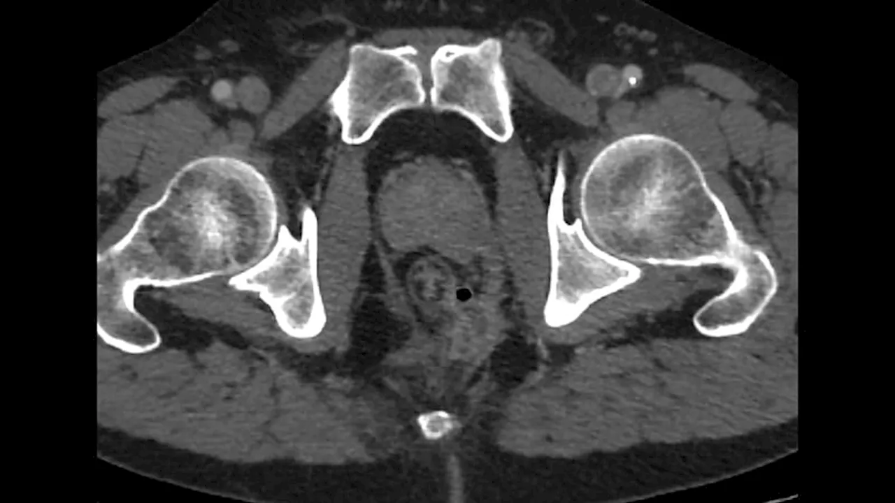 Did Reimbursement Rule Influence How Surgeons Size Hernias?