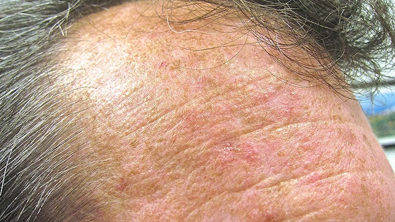 High Incidence of Actinic Keratosis in Solid Organ Transplant Recipients