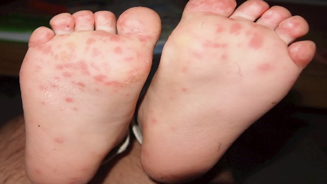 Two Schools in Phoenix Report Cases of Hand, Foot, and Mouth Disease