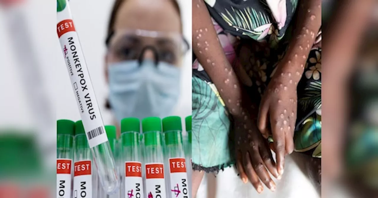 Mpox: फिर निकला मंकीपॉक्स का जिन्न, इस जगह मरीजों की तादाद हुई 40 के पार