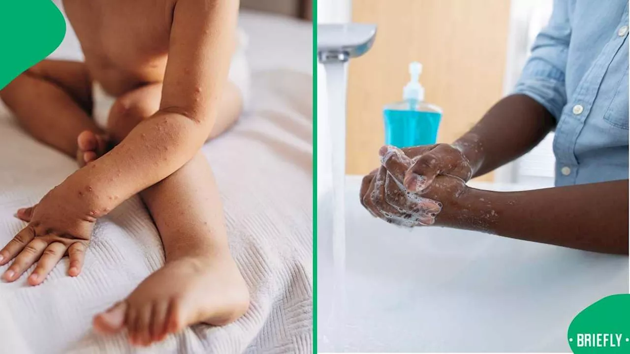 KZN Calls for Best Hygienic Practices As Health Department 117 Foot and Mouth Disease Cases Recorded