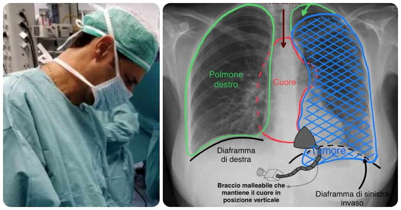 Chirurgia di 10 ore salva uomo di 55 anni da tumore al timo