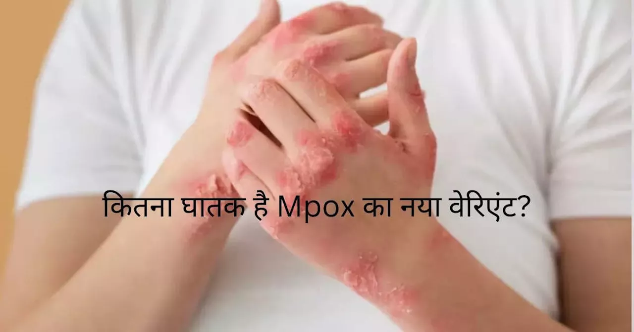 अमेरिका में पाया गया मंकीपॉक्स का नया स्ट्रेन, कितना खतरनाक है और क्या हैं लक्षण