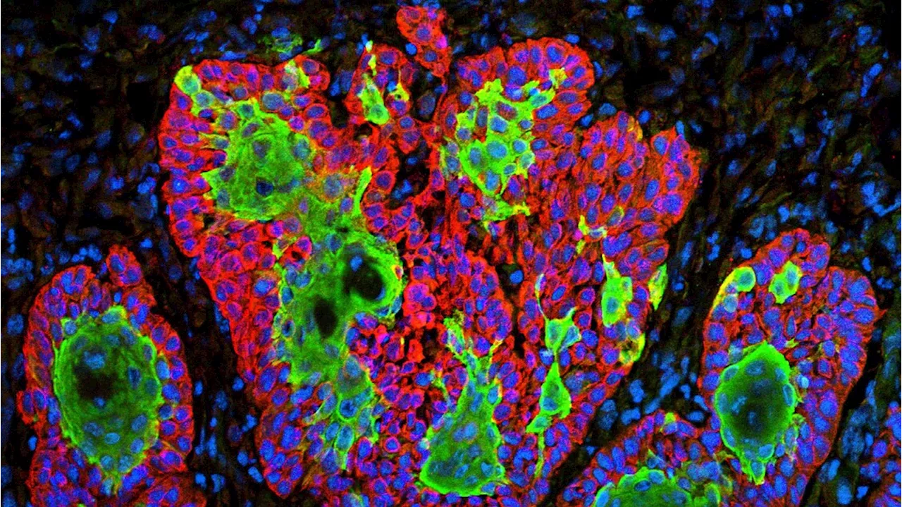 Trovato il punto debole delle cellule tumorali più resistenti