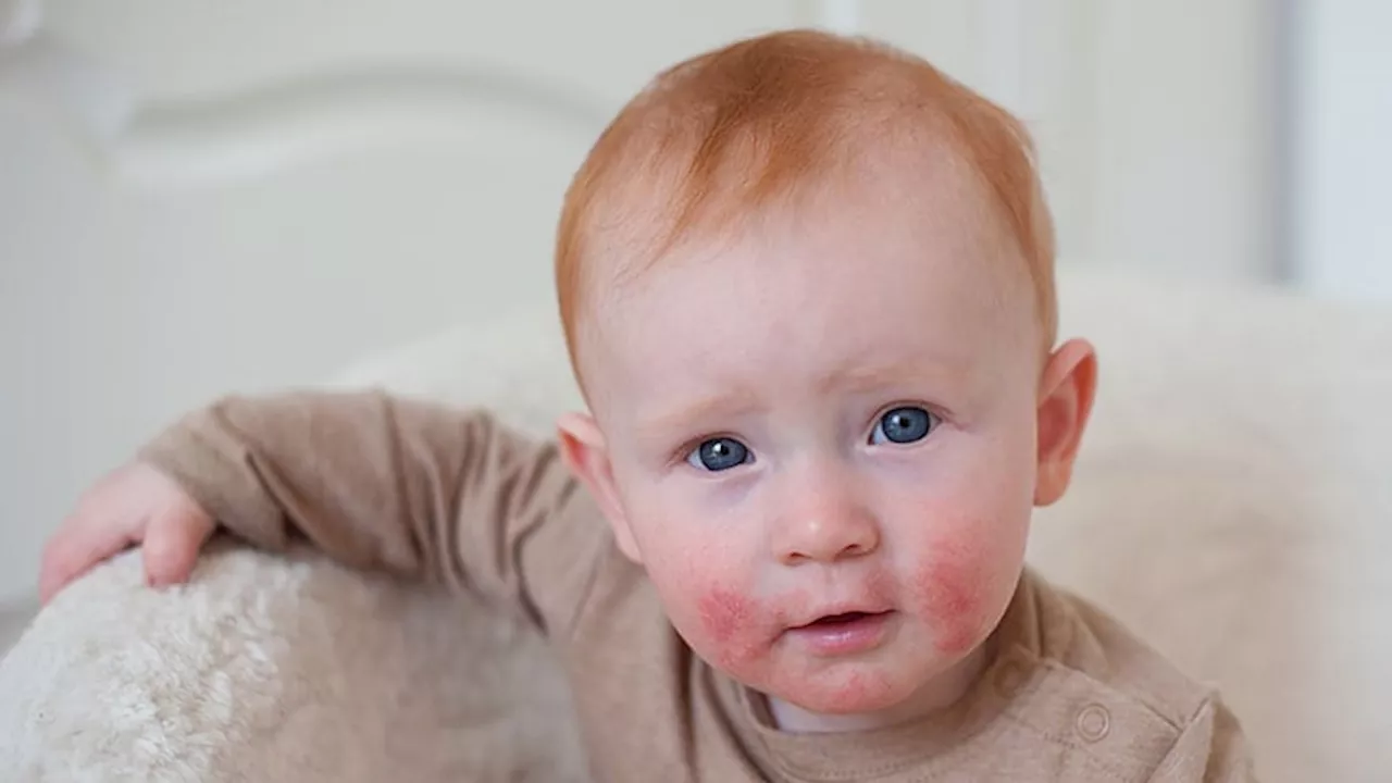 Early Childhood Stress Linked to Increased Atopic Dermatitis Activity