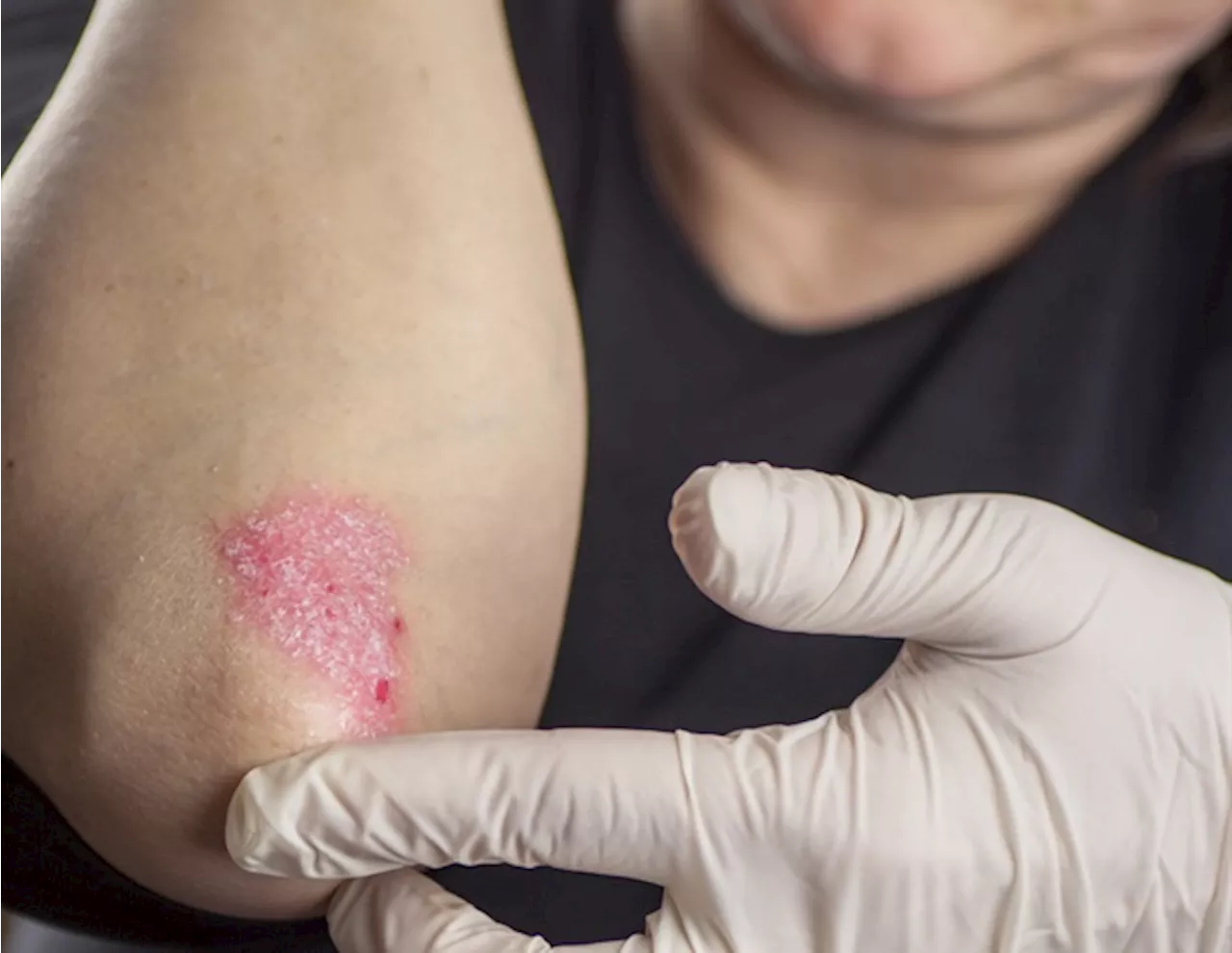 New compound shows promise for treating psoriasis with blue light activation