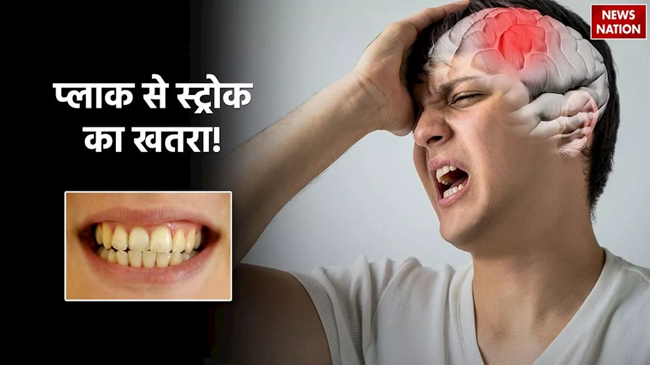 Oral Health: दांतों और मसूड़ों के बीच पीली गंदगी जमने से स्ट्रोक का खतरा, शोध में खुलासा