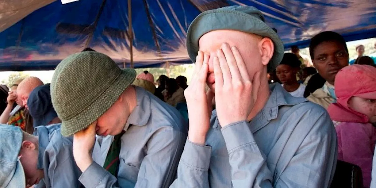 Albinism association urges FG to include skin cancer in health insurance