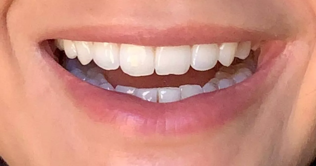 MySweetSmile Teeth Whitening Deals for February