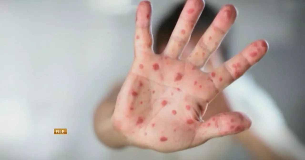 Officials warn of possible measles exposure at 2 locations in Newmarket