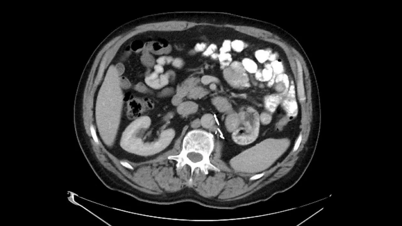 Vacina Personalizada Mantém Pacientes com Cancro Renal Livres de Doença por Três Anos