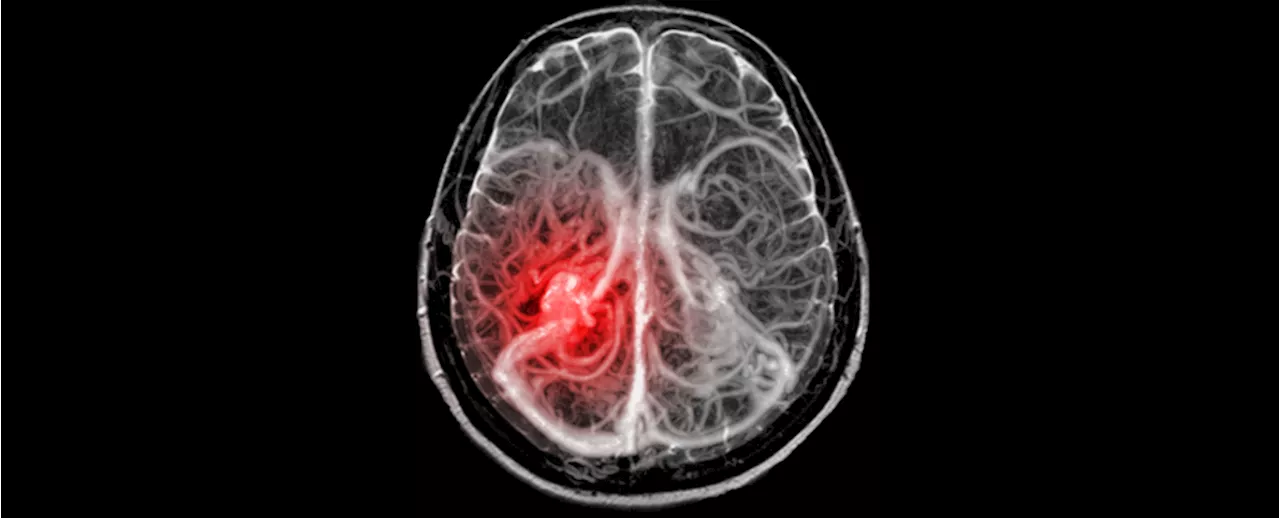 Understanding Brain Aneurysms: Causes, Risks, and Treatment