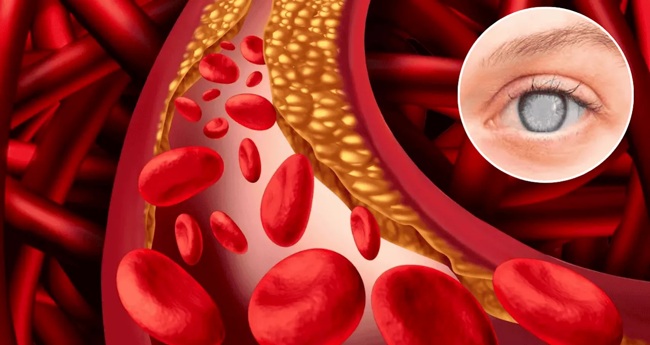 Colesterol HDL y Glaucoma: Un Nuevo Estudio Desafía la Tradición