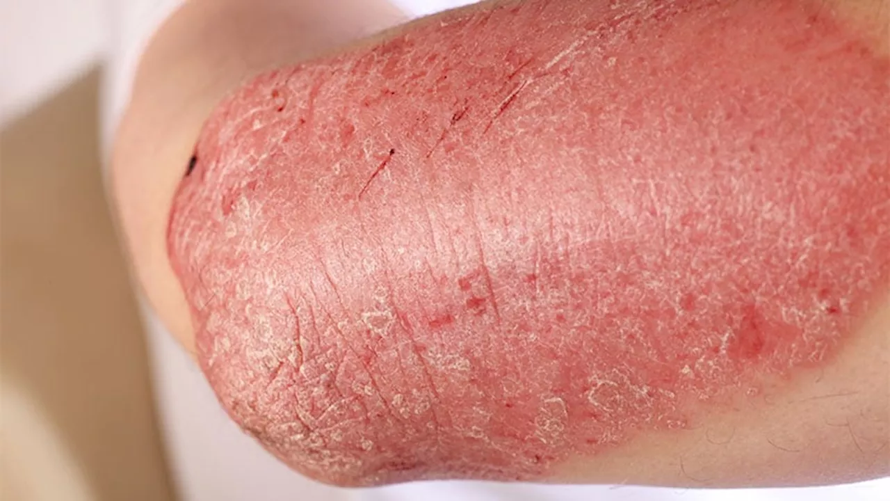 Long-Term Bimekizumab Shows Sustained Benefits in Moderate to Severe Plaque Psoriasis