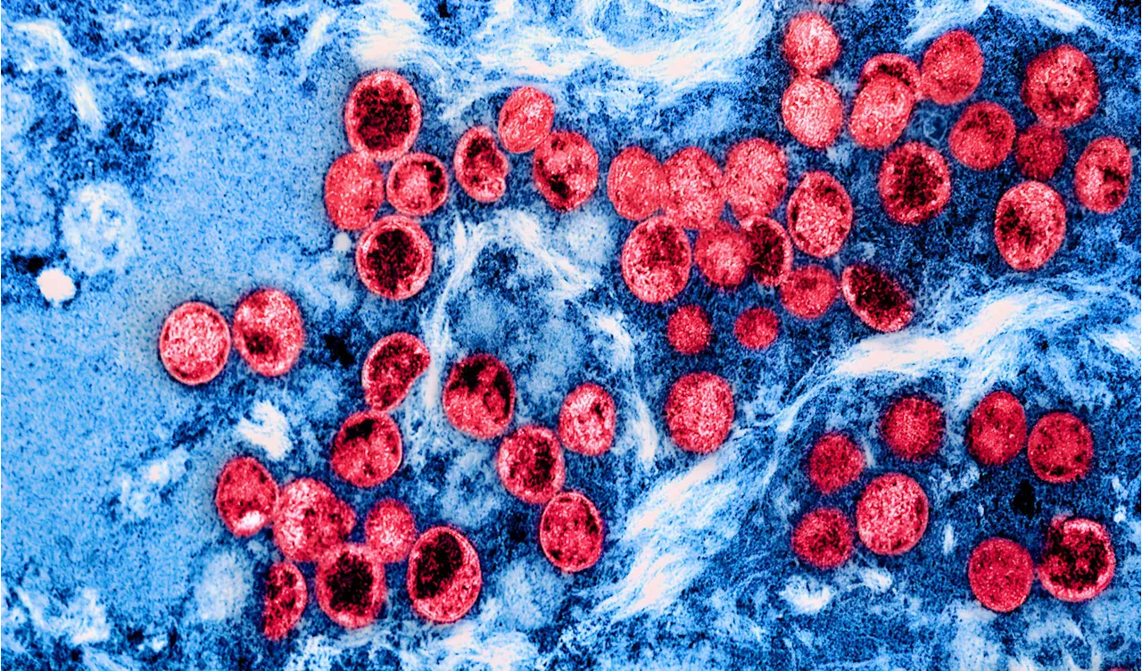 NH reports 3rd US case of mpox variant