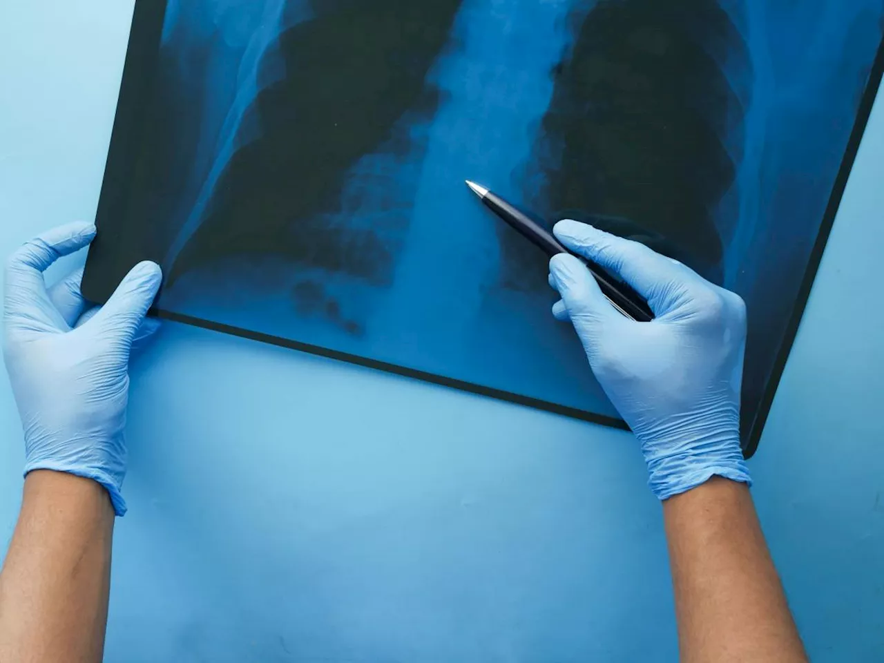 Inquinamento e Cancro ai Polmoni: Una Crescente Minaccia per i Non Fumatori