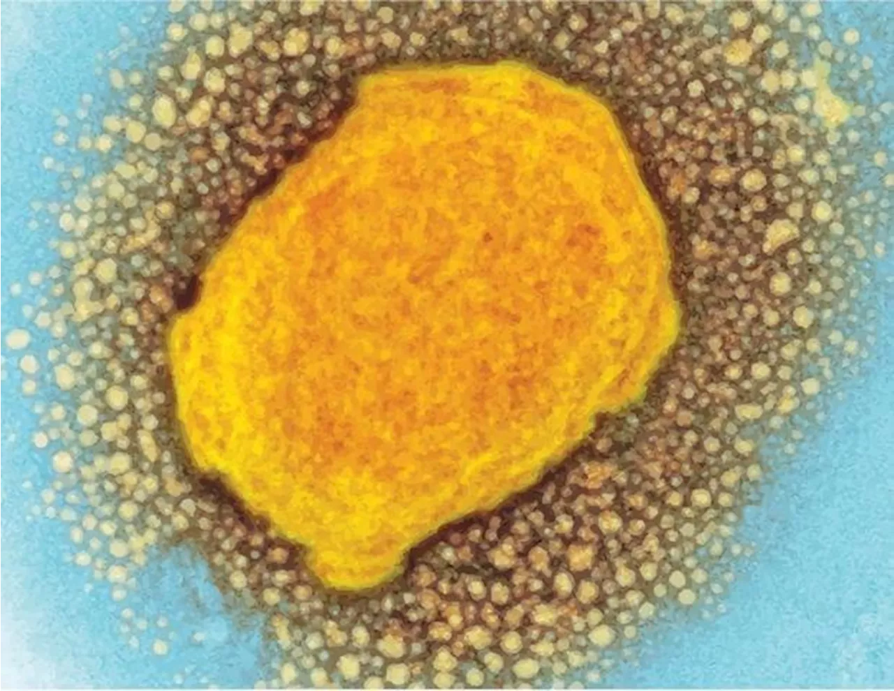 Tecovirimat monotherapy found ineffective for treating clade II mpox in NIH-sponsored trial