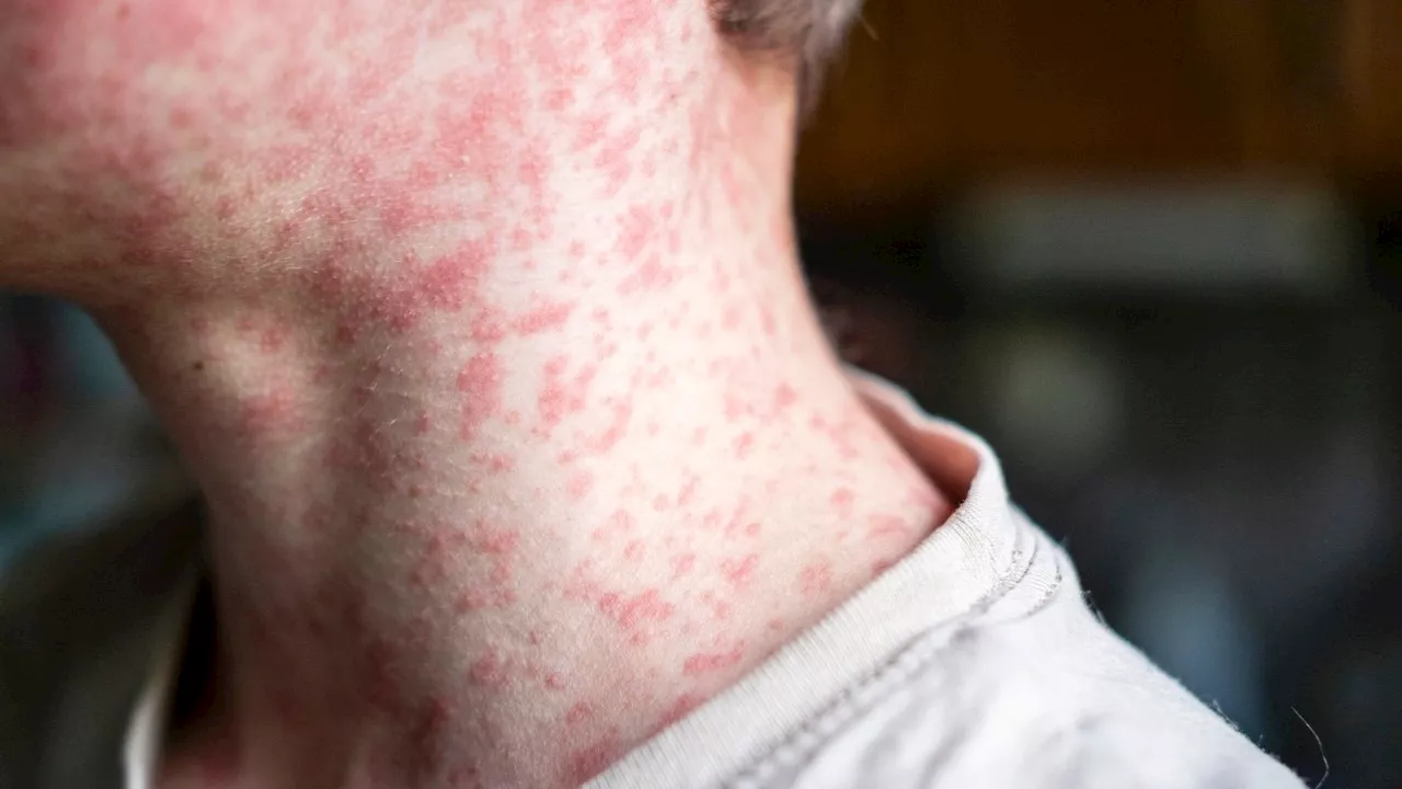 Urgent measles alert after infectious traveller arrives in Sydney from Vietnam