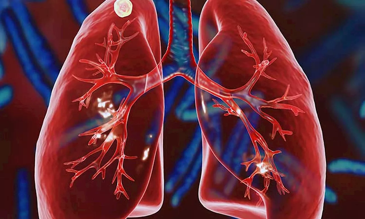 TB cases rise in Davao City in 2024