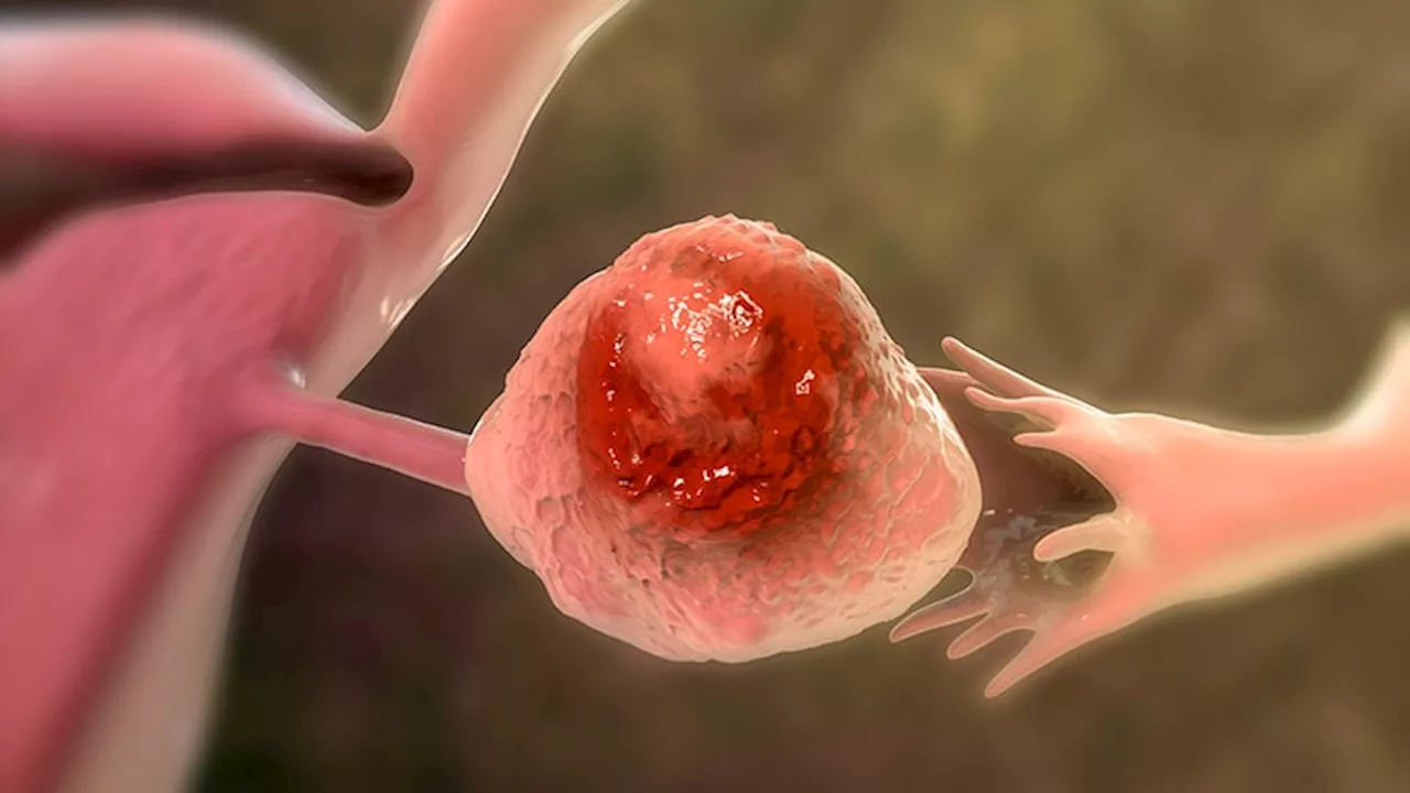 Electronic Medical Record Prompt Speeds Referral to GYN Oncology