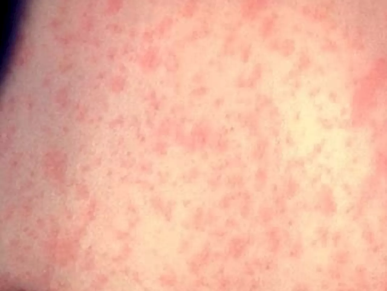 Measles outbreak in Ohio: 10 cases in Ashtabula County, possible exposures in Knox County