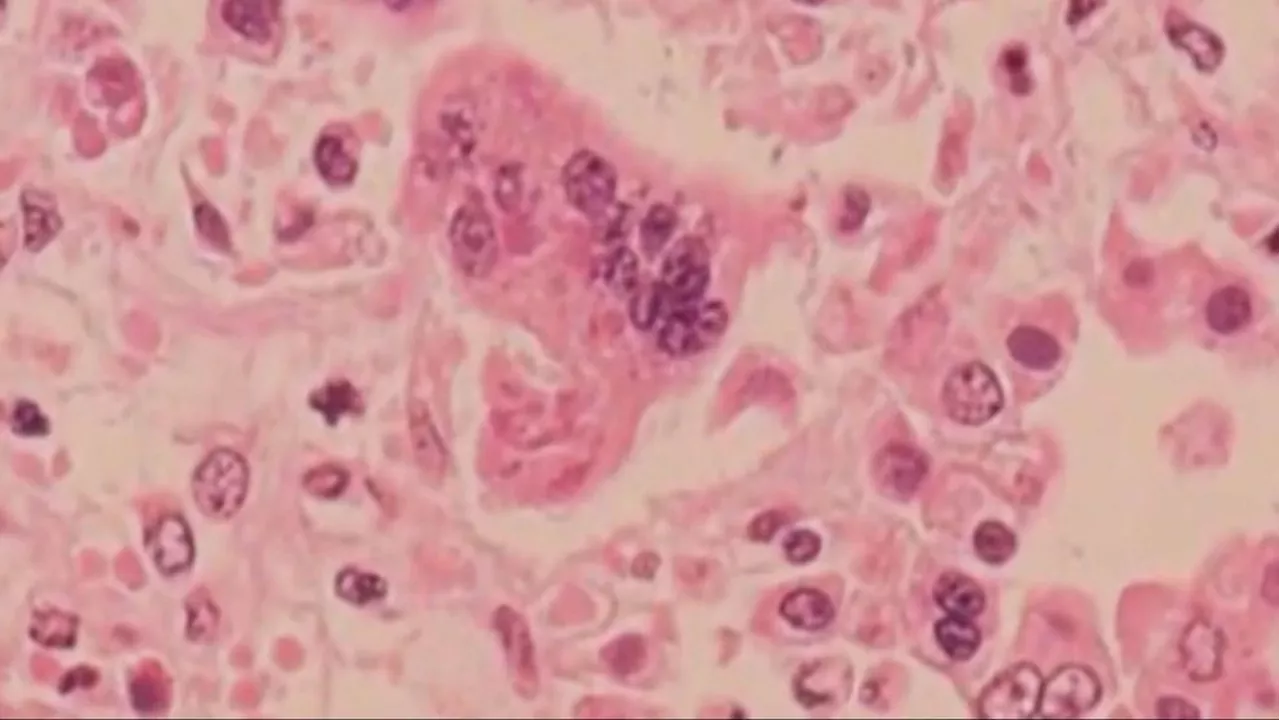 Outbreak: Ohio identifies more measles cases after initial case discovered last week