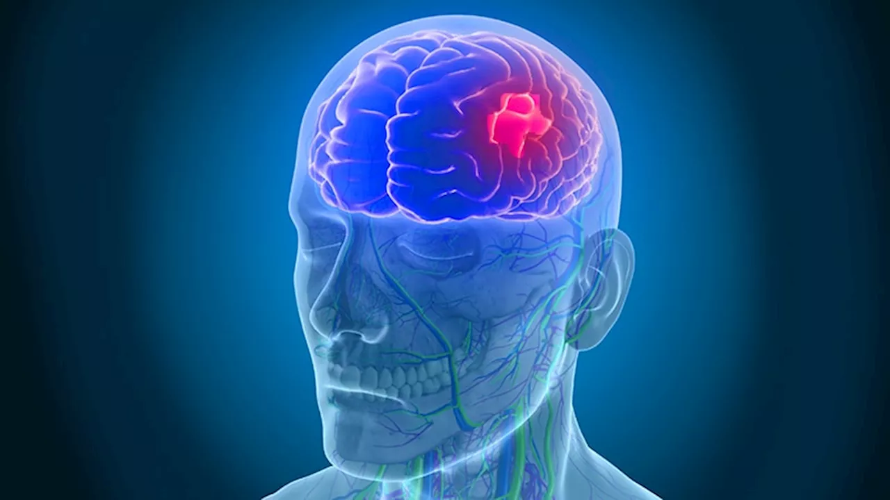 Which Diabetes Type Has Higher Stroke Risk?