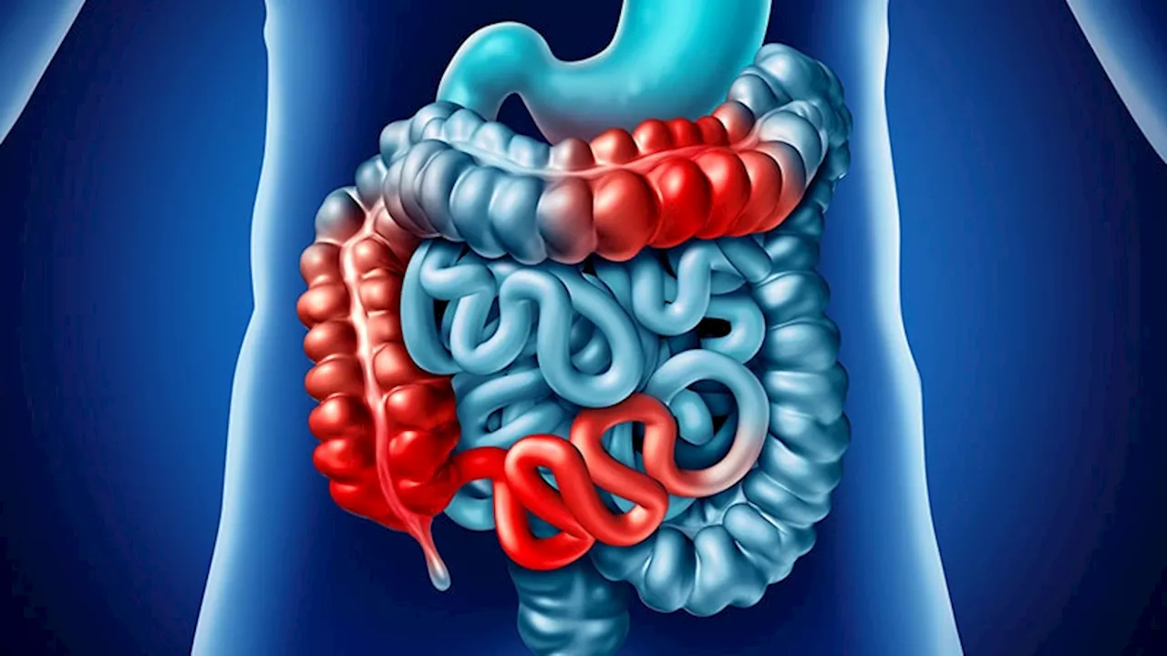 Beyond Anti-TNF: Is Ustekinumab a Better Choice in Crohn's?