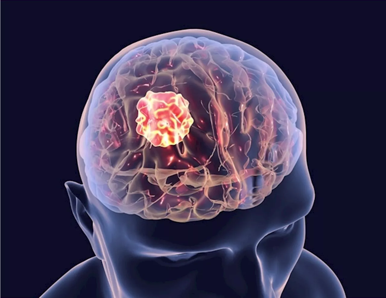 Engineered TIMPs show promise in fighting glioblastoma invasion