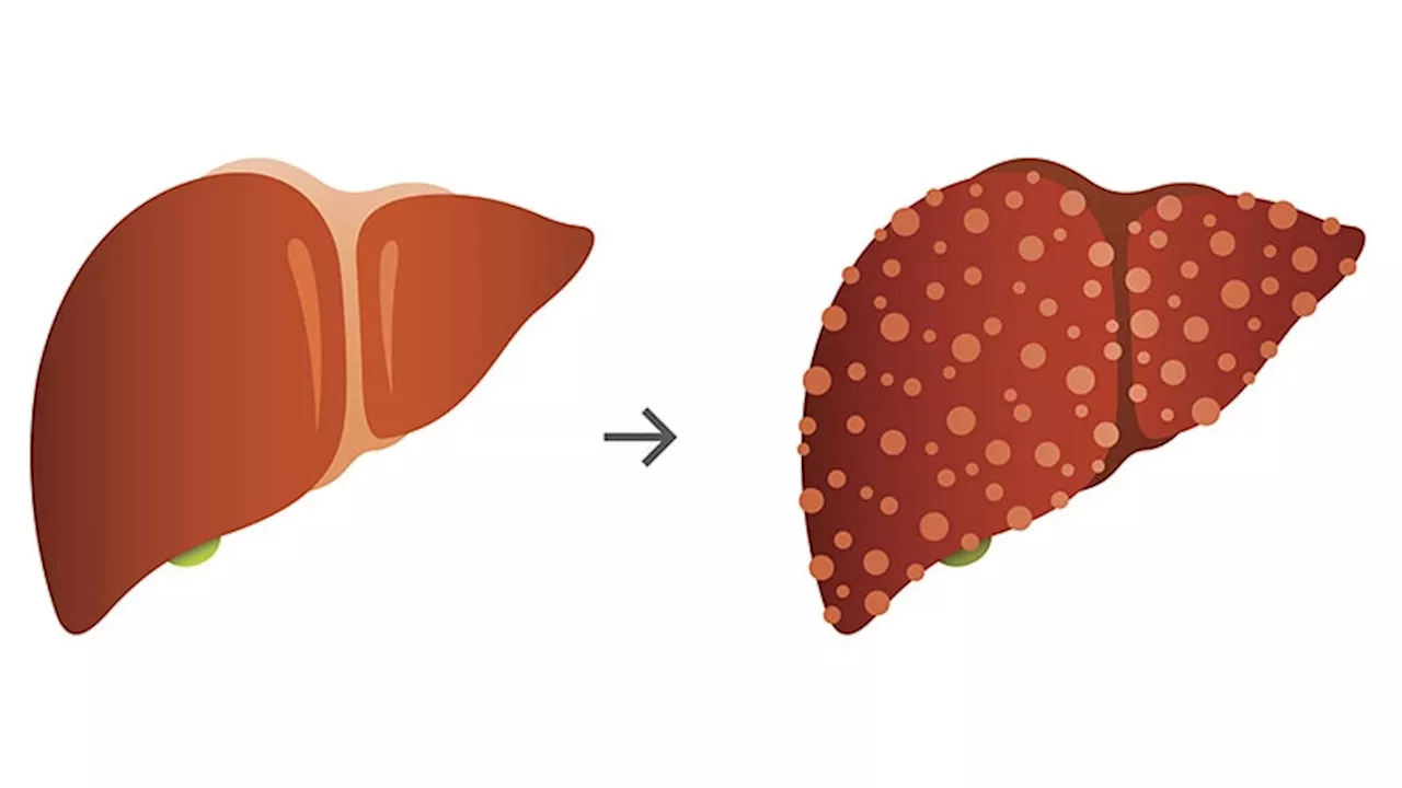 Preventing Hepatitis B Reactivation: Updated Clinical Guidance From AGA