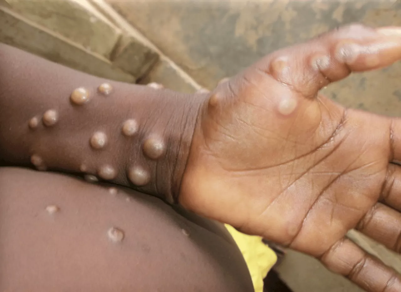 Davao CHO monitors contacts of Mpox cases