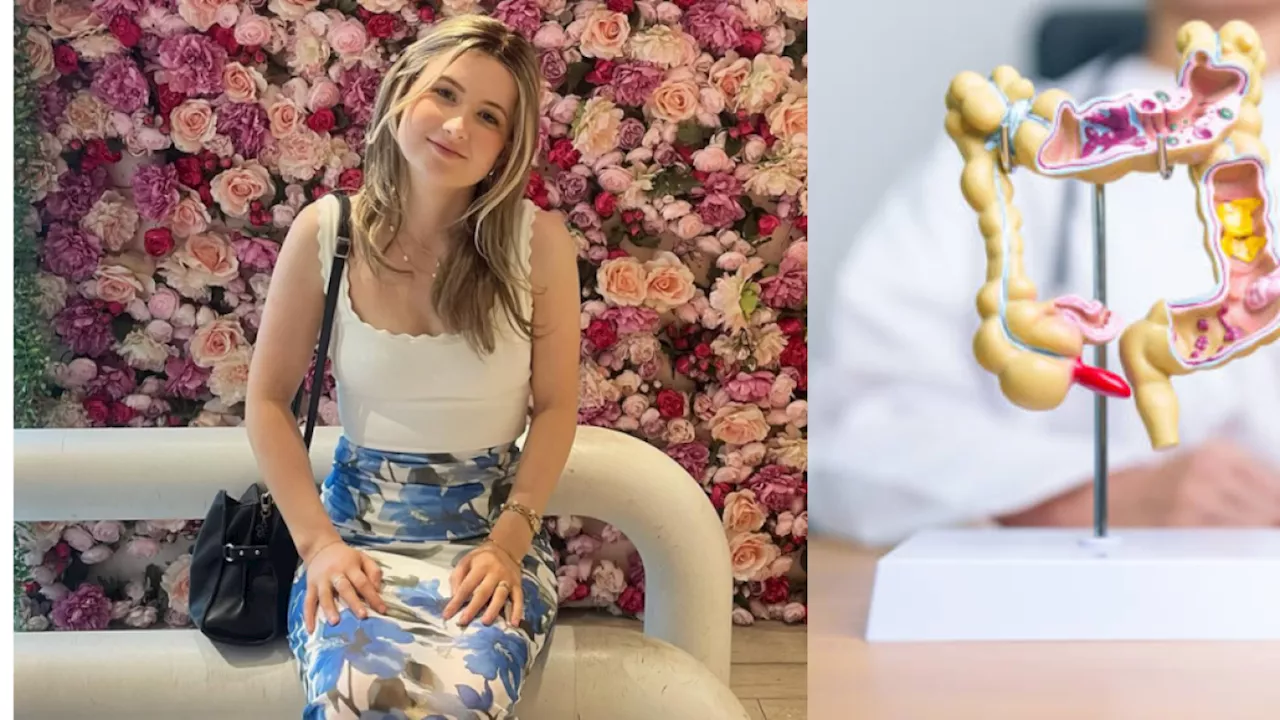 Murió ‘influencer’ de 21 años diagnosticada con cáncer de colon: oncólogo explica cómo prevenirlo y síntomas