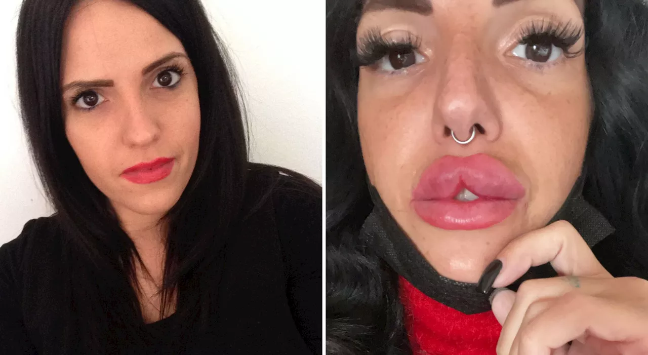 «Sfigurata da un filler low cost. Volevo le 'labbra alla russa'»: la denuncia di Federica, sfigurata dall'inie
