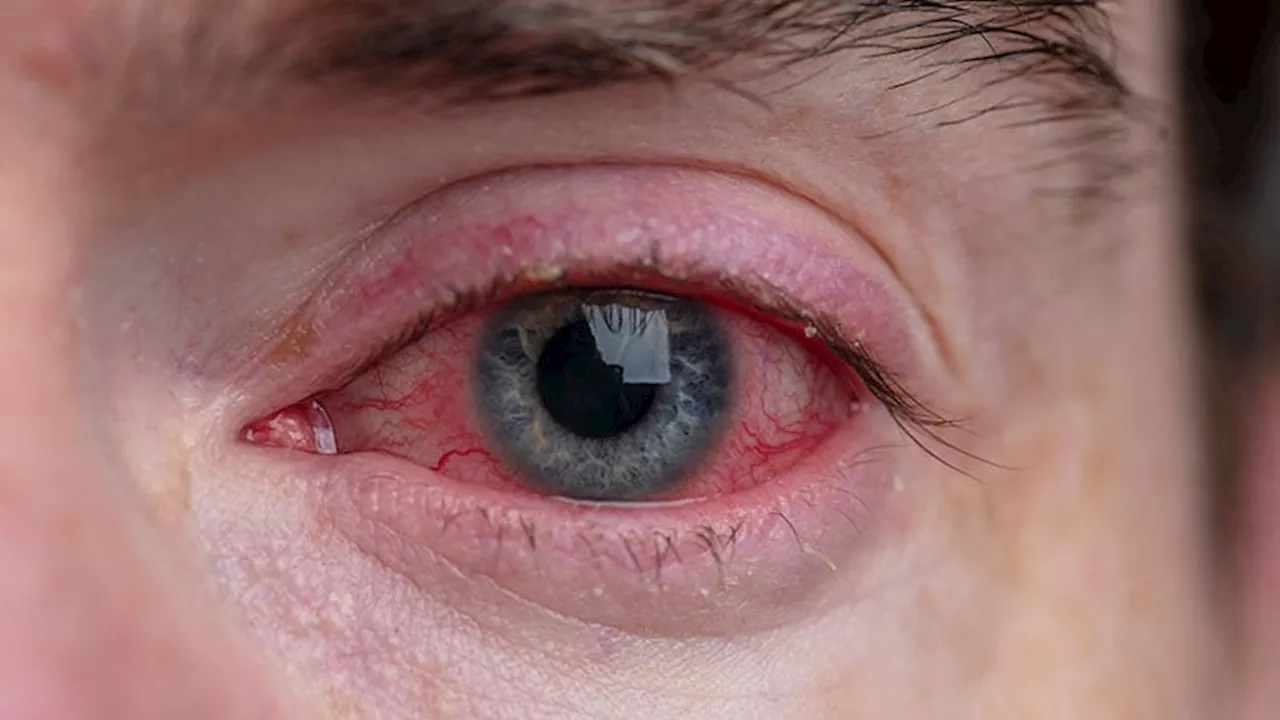 How Climate Change Threatens Eye Health