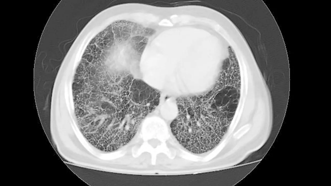 Less FVC Decline in Progressive PF With Oral Nerandomilast