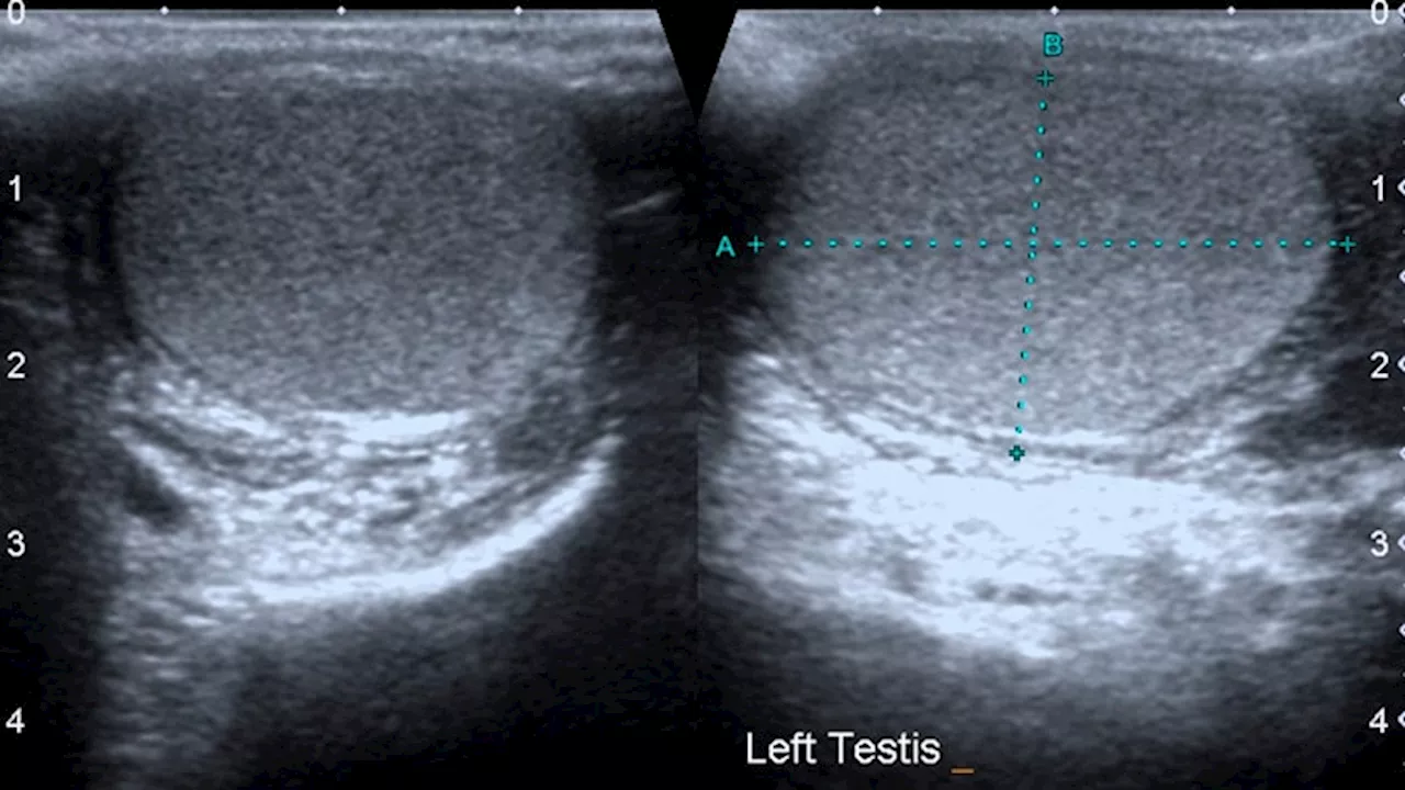 Ultrasound Shows 95% Accuracy in Diagnosing Testicular Torsion, Meta-analysis Confirms