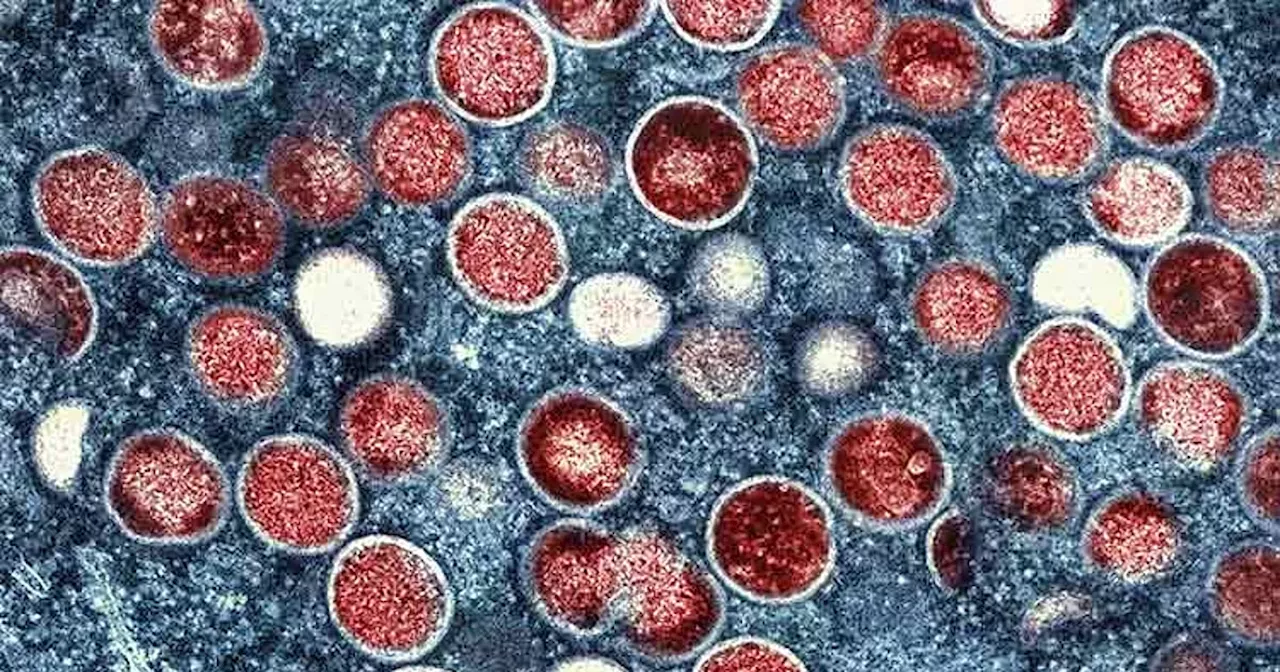 Mayor: No Mpox cases in Digos