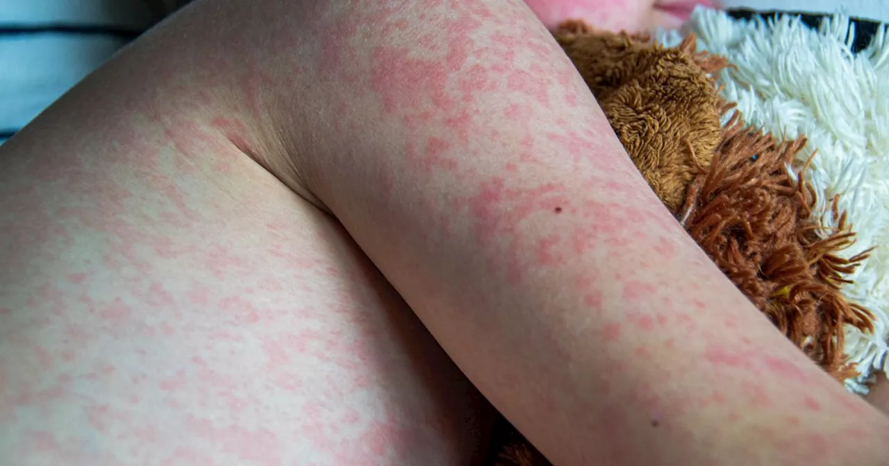 Measles cases soar in Scotland as health chiefs issue vaccination plea