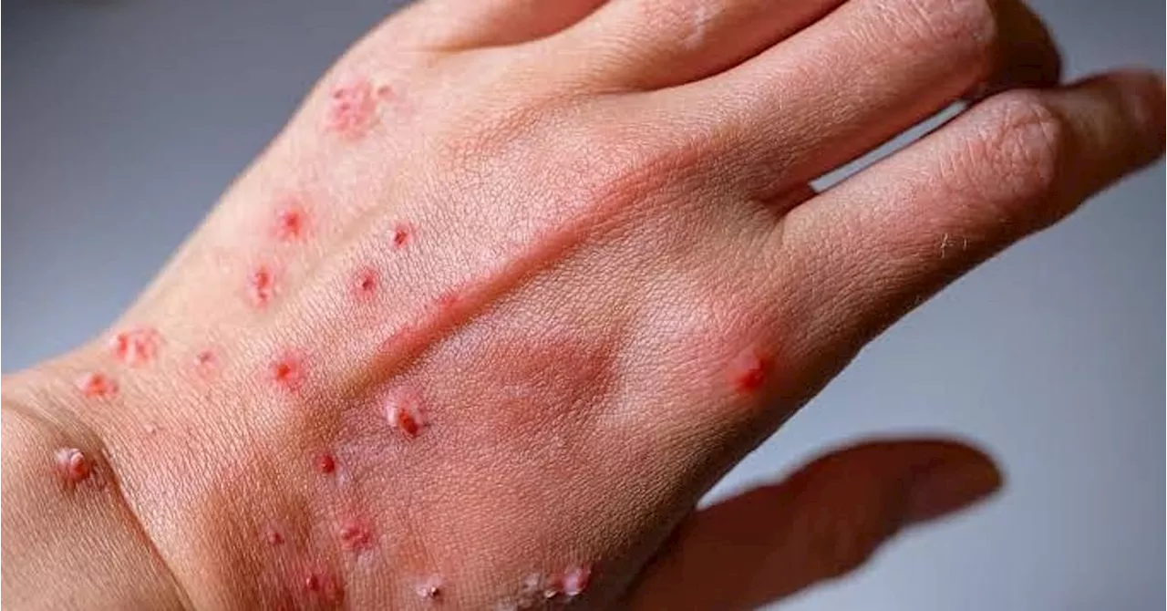 3 Mpox cases in Davao de Oro