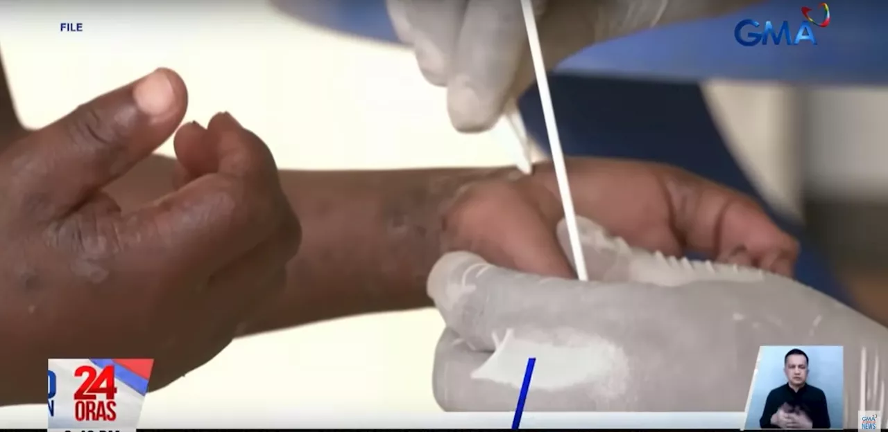 Variant ng monkeypox o mpox sa PH, mild lang, ayon sa DOH