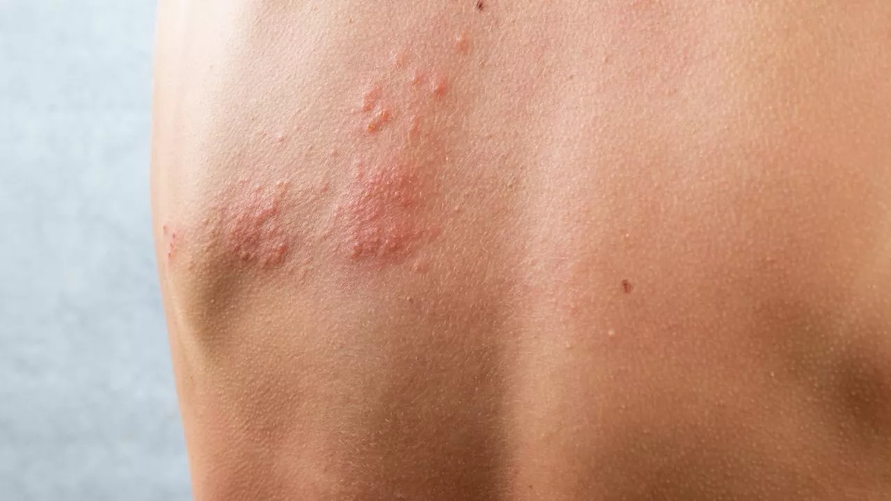 Herpes zoster o fuoco di Sant'Antonio: perché è pericoloso, ma sottovalutato in Italia