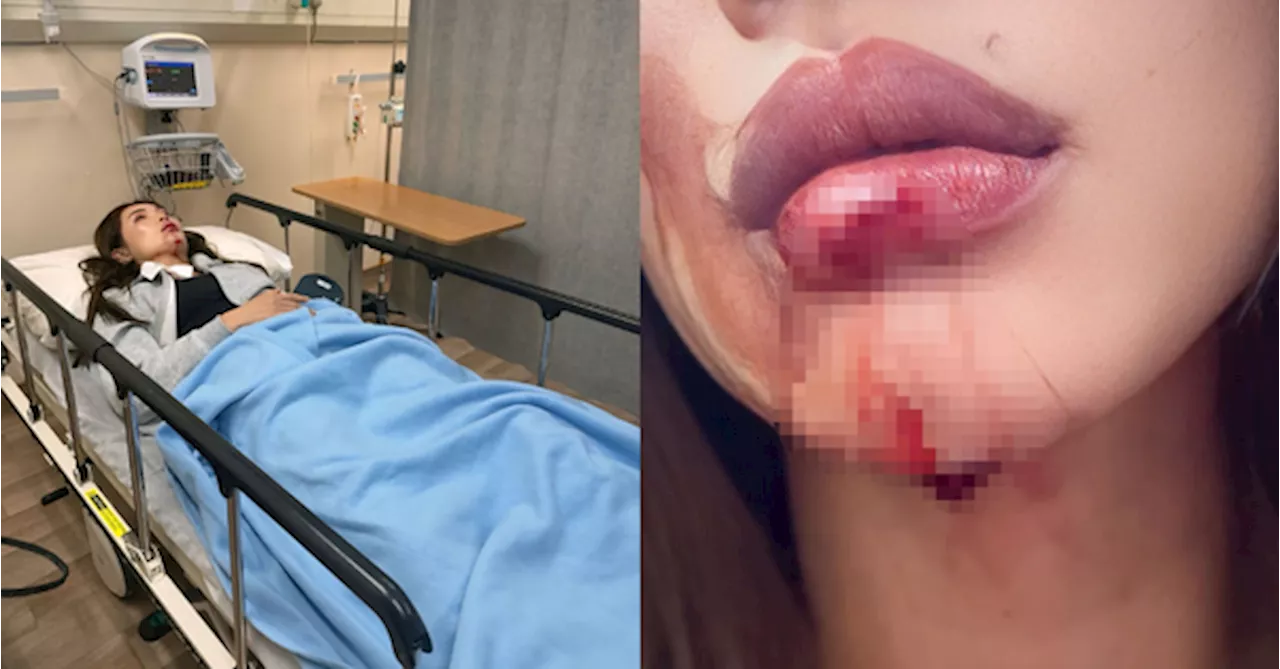 Supermodel Amber Chia Suffers Bloody Chin After Fainting At Home