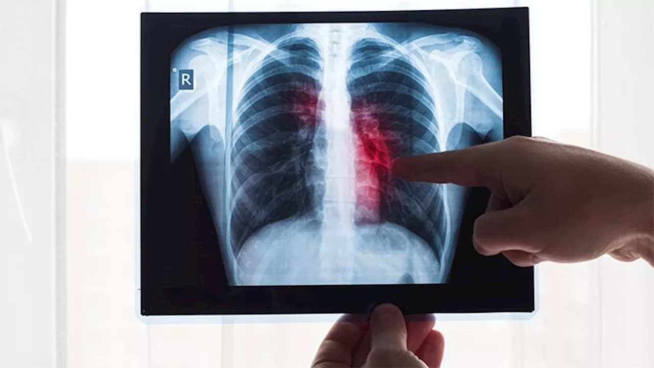Resistant Pneumonia Case Shakes Up Diagnostic Rules