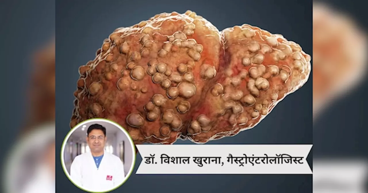 Explainer: इम्यूनोथेरेपी क्या है? बिना ट्रांसप्लांट सिरोसिस से सड़े लिवर को ठीक किया जा सकता है? जानें गैस्ट्रोएंटरोलॉजिस्ट की राय