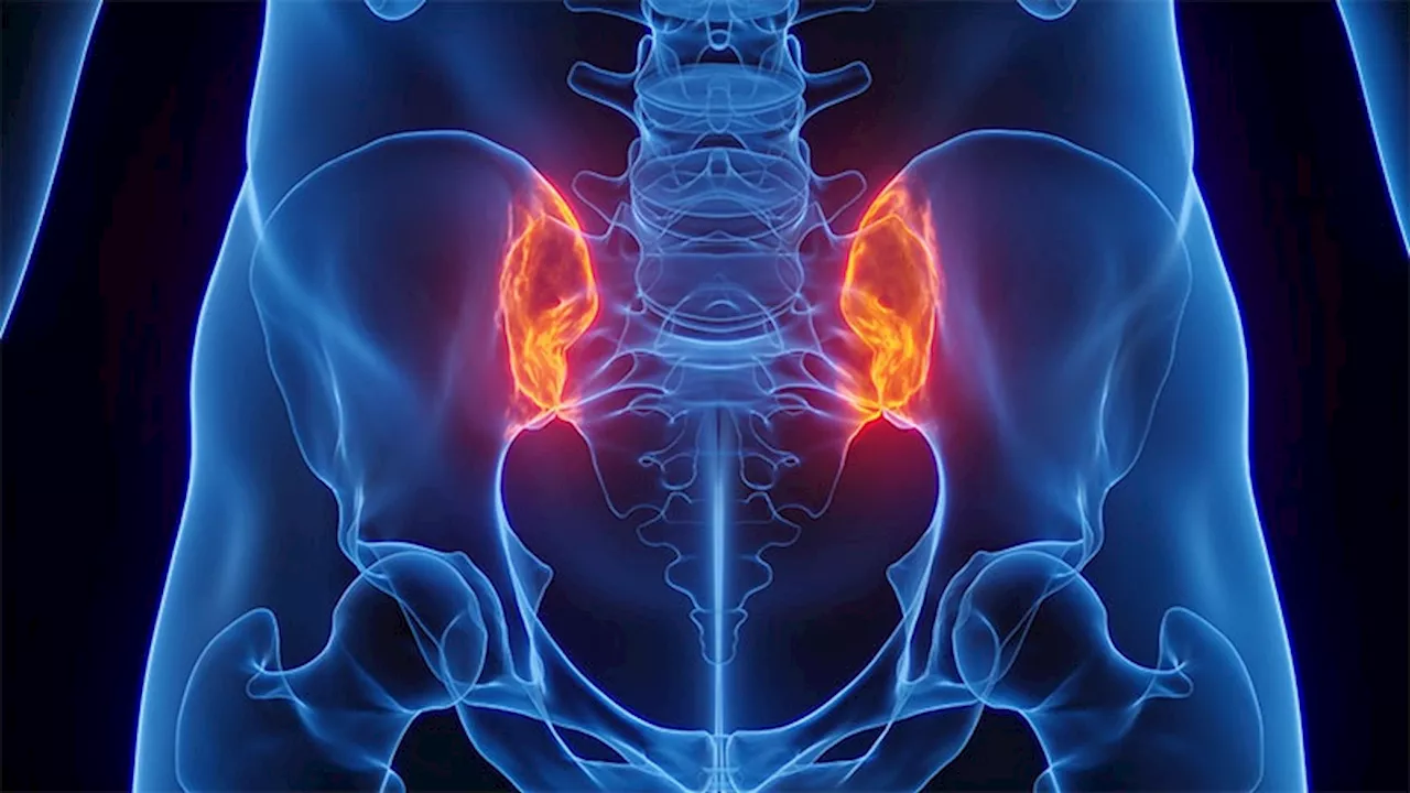 Do NSAIDs Affect Sacroiliitis Visibility on MRI in Axial Spondyloarthritis?